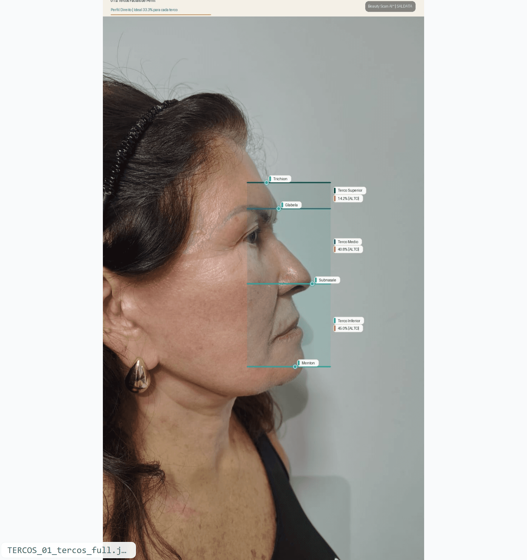 Terços faciais — perfil